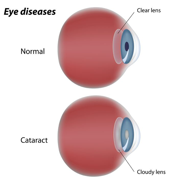 Cataracts Exams Toms River