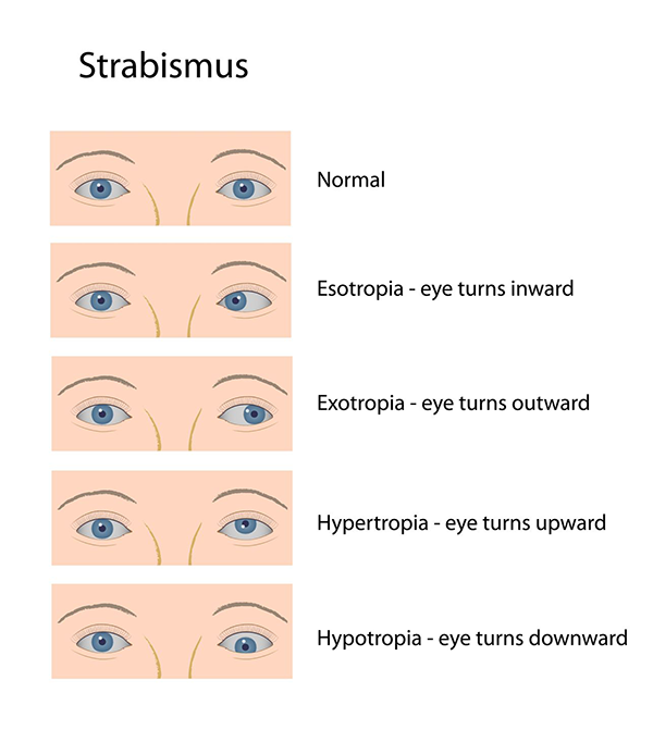 Strabismus Exams in Toms River