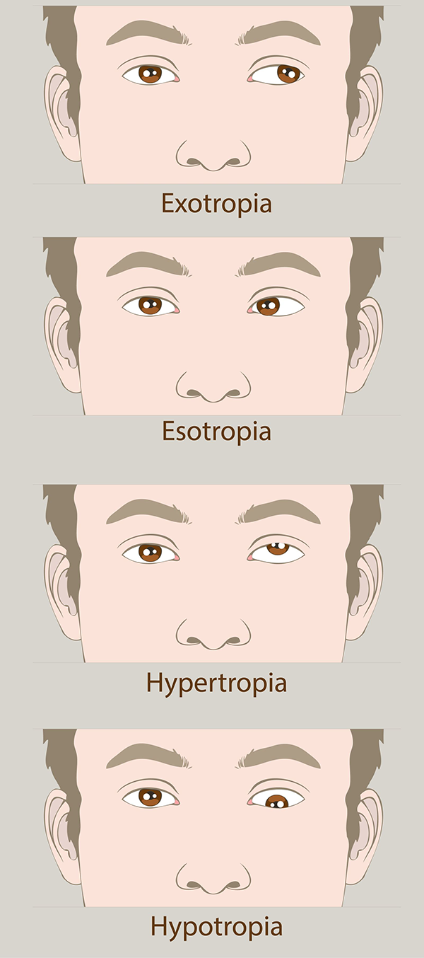 Amblyopia Treatment in Toms River