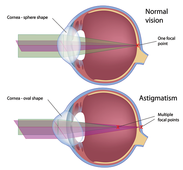 Toms River Astigmatism Treatments