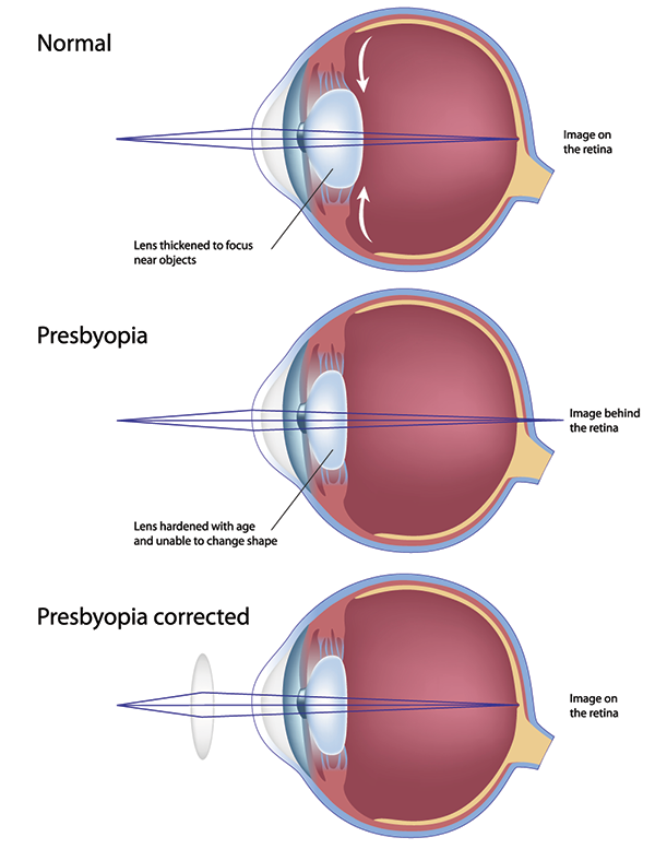 Presbyopia Exams in Toms River